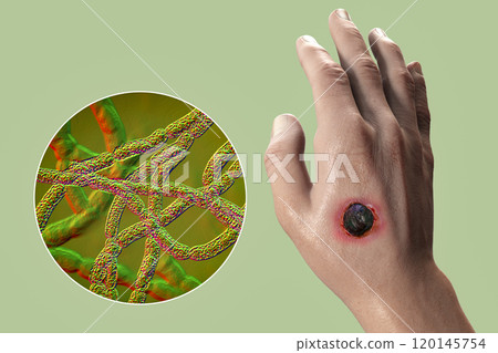 Cutaneous anthrax, the most common form of anthrax 120145754