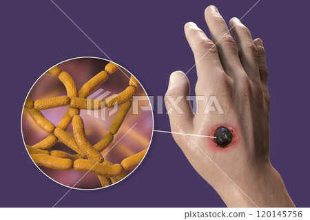 Cutaneous anthrax, the most common form of anthrax Cutaneous anthrax, the most common form of anthrax 120145756