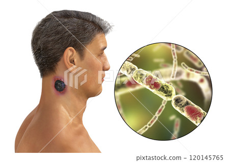 Cutaneous anthrax, the most common form of anthrax Cutaneous anthrax, the most common form of anthrax 120145765