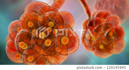 Coronavirus pneumonia, alveoli with Covid-19 Coronavirus pneumonia, alveoli with Covid-19 120145945