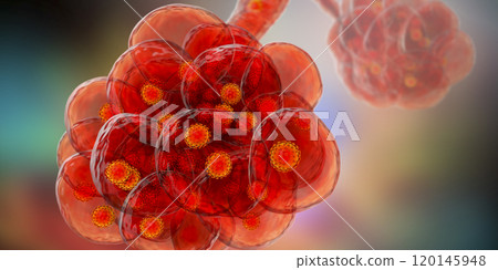 Coronavirus pneumonia, alveoli with Covid-19 120145948