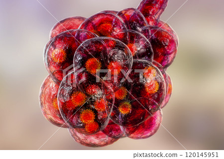 Coronavirus pneumonia, alveoli with Covid-19 Coronavirus pneumonia, alveoli with Covid-19 120145951