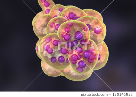Coronavirus pneumonia, alveoli with Covid-19 Coronavirus pneumonia, alveoli with Covid-19 120145955