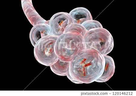Bacteria pneumonia, medical concept 120146212