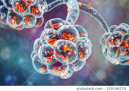 Bacterial pneumonia, medical concept Bacterial pneumonia, medical concept 120146219