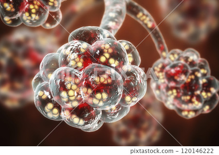 Pneumococcal pneumonia, medical concept 120146222