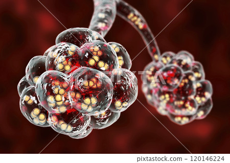 Pneumococcal pneumonia, medical concept 120146224