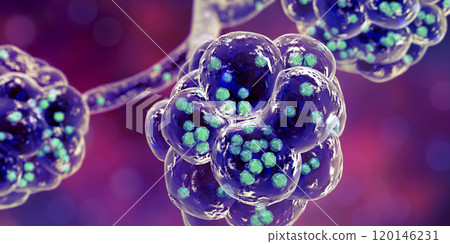 Staphylococcal pneumonia, medical concept 120146231