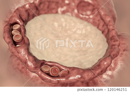 Pulmonary edema, close-up view of alveolus cross-section showing liquid in alveolus 120146251