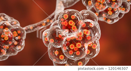 Coronavirus pneumonia, alveoli with Covid-19 Coronavirus pneumonia, alveoli with Covid-19 120146307
