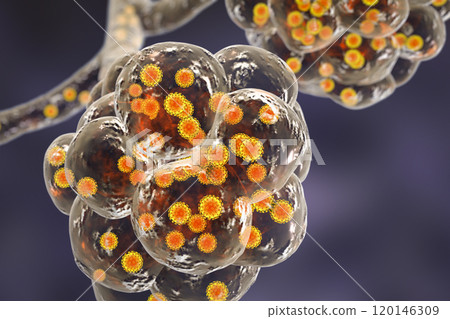 Coronavirus pneumonia, alveoli with Covid-19 Coronavirus pneumonia, alveoli with Covid-19 120146309