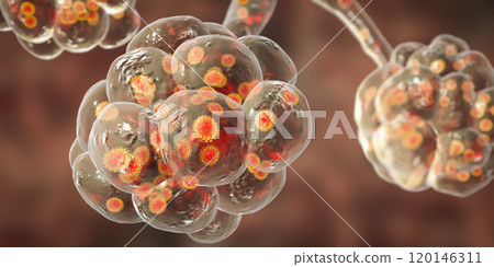 Coronavirus pneumonia, alveoli with Covid-19 Coronavirus pneumonia, alveoli with Covid-19 120146311