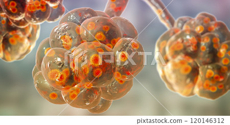 Coronavirus pneumonia, alveoli with Covid-19 Coronavirus pneumonia, alveoli with Covid-19 120146312
