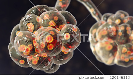 Coronavirus pneumonia, alveoli with Covid-19 Coronavirus pneumonia, alveoli with Covid-19 120146313