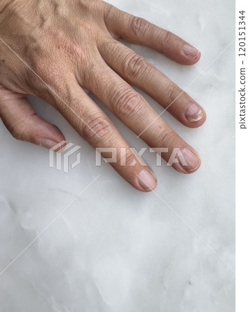 Fungal nail infection on finger of woman 120151344