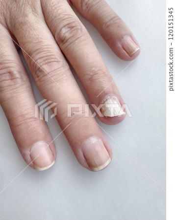 nail fungus infection on hand finger of woman 120151345