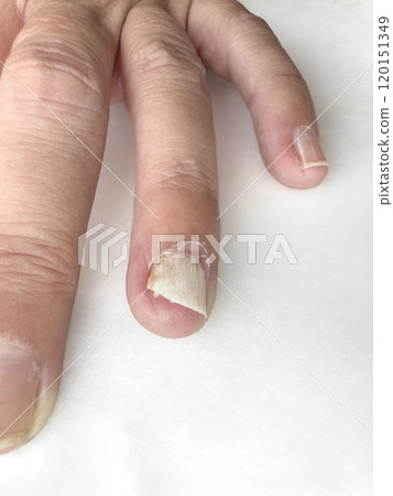 female hand with separation of flesh from nail female hand with separation of flesh from nail 120151349