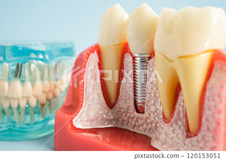 Dental implant, artificial tooth roots into jaw, root canal of dental treatment, gum disease, teeth model for dentist studying about dentistry. 120153051