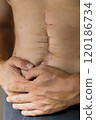 A person exhibits visible surgical scars on their torso, indicating a recent medical operation, highlighting the healing process and resilience of the human body. intestinal surgery 120186734