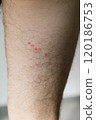 Red marks appear on the skin of a lower leg, suggesting irritation or a reaction possibly due to insect bites or allergies in a well-lit indoor environment. 120186753
