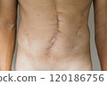 A male subject stands upright, revealing a prominent abdominal incision scar. The background is neutral, focusing on the scar that reflects recent surgery. 120186756