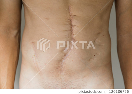 A male subject stands upright, revealing a prominent abdominal incision scar. The background is neutral, focusing on the scar that reflects recent surgery. 120186756
