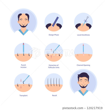 Cartoon Color Hair Transplantation Process Alopecia and Hairloss Treatment Infographic Concept Flat Design Style. Vector illustration Cartoon Color Hair Transplantation Process Alopecia and Hairloss Treatment Infographic Concept Flat Design Style. Vector illustration 120217919