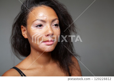 Close-Up Portrait of African Woman with Vitiligo 120228812
