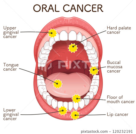 Oral cancer illustration Oral cancer illustration 120232191