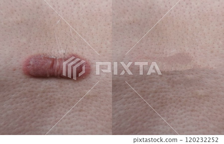 Keloid scars before and after treatment. 120232252