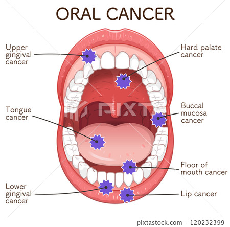 Oral cancer illustration 120232399