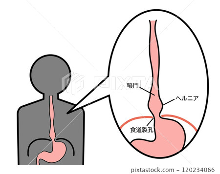 Hiatal hernia, sliding type, with text Hiatal hernia, sliding type, with text 120234066