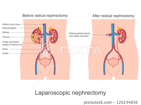 Kidney removal or nephrectomy is surgery to remove. Kidney removal or nephrectomy is surgery to remove. 120234856