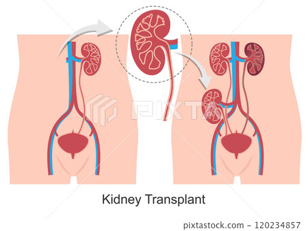 Kidney transplant is a surgery done to replace a diseased or injured kidney . 120234857