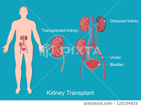 Kidney transplant is a surgery to place a healthy kidney. Kidney transplant is a surgery to place a healthy kidney. 120234858