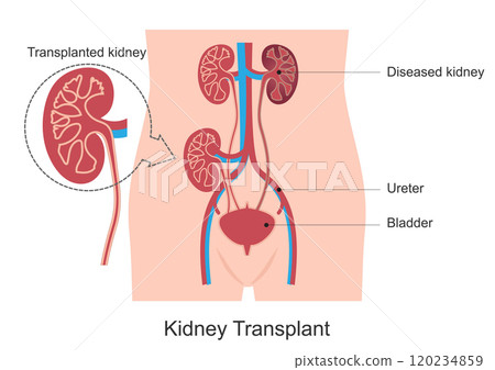 Kidney transplant or renal transplant. Kidney transplant or renal transplant. 120234859