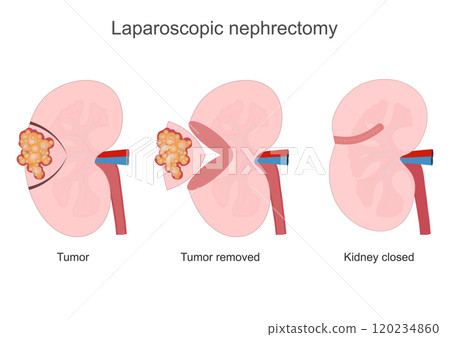 Nephrectomy is a major procedure performed. Nephrectomy is a major procedure performed. 120234860
