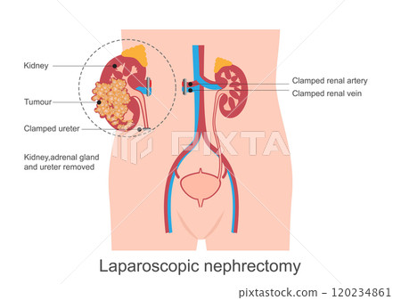 Nephrectomy is the surgical removal of a kidney. 120234861