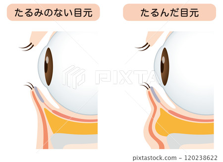 Sagging under the eyes: Firm eyes and sagging eyes 120238622