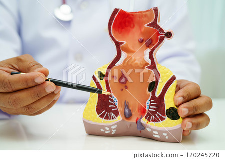 Asian doctor with rectum and hemorrhoid human anatomy model at hospital, inflamed vascular structure. Asian doctor with rectum and hemorrhoid human anatomy model at hospital, inflamed vascular structure. 120245720