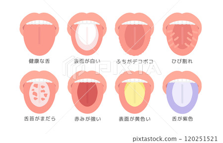 舌頭健康狀態類型插圖集(附說明) 舌頭健康狀態類型插圖集(附說明) 120251521