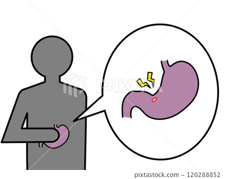Stomach pain due to stomach ulcer Stomach pain due to stomach ulcer 120288852