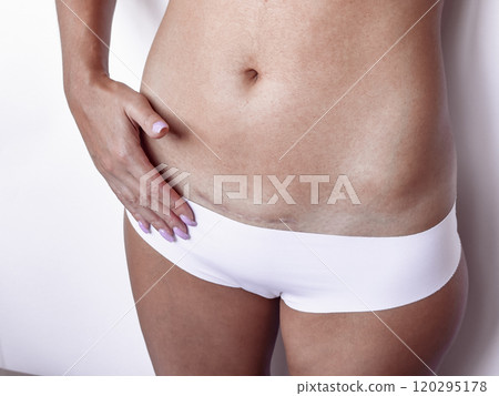 Close-up of woman's abdomen with c-section scar and white underwear 120295178