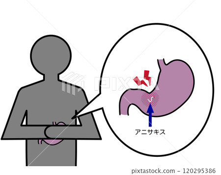 胃異尖線蟲病引起的腹痛(附文字) 胃異尖線蟲病引起的腹痛(附文字) 120295386