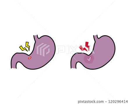 Gastric ulcers and gastric anisakiasis 120296414