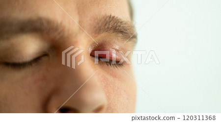 Selective focus on swollen and painful red upper eye lid with onset of stye infection due to clogged oil gland and staphylococcal bacteria. Close up right upper eyelid abscess. 120311368