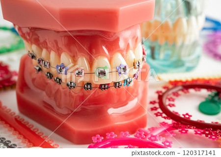 Orthodontic ligatures rings and ties, elastic rubber bands on orthodontic braces, model for dentist studying about dentistry. Orthodontic ligatures rings and ties, elastic rubber bands on orthodontic braces, model for dentist studying about dentistry. 120317141
