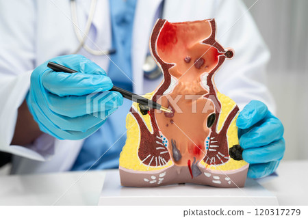 Asian doctor with rectum and hemorrhoid human anatomy model at hospital, inflamed vascular structure. 120317279