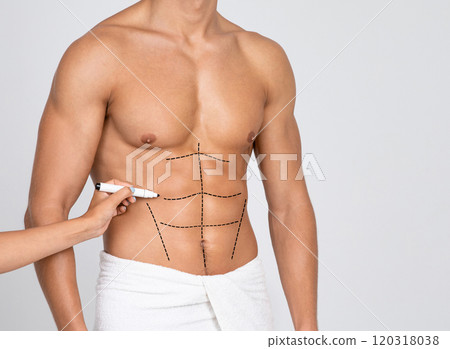 Plastic Surgery. Man's Fit Torso With Surgical Lines On His Body Before Operation. Doctor's Hand Drawing Black Marks 120318038