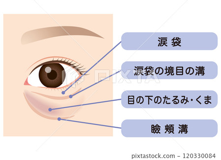Bags under the eyes, sagging lower eyelids Bags under the eyes, sagging lower eyelids 120330084